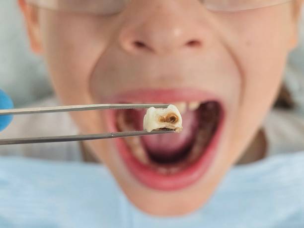 Best Emergency Dental Care for Abscessed Tooth in Travis Ranch, TX